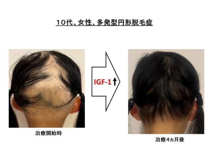 円形脱毛症　病院